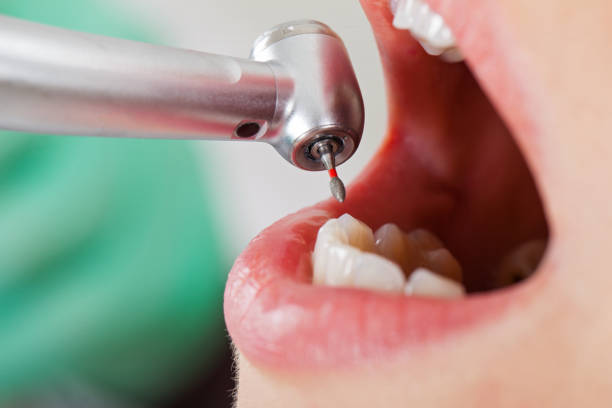 Best Emergency Tooth Extraction in Isle Of Palms, SC
